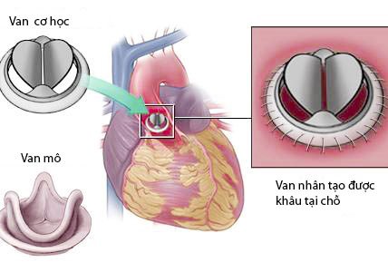Quảng Ninh: Lần đầu tiên áp dụng kỹ thuật tiêu sợi huyết cứu sống người bệnh bị kẹt van tim nhân tạo